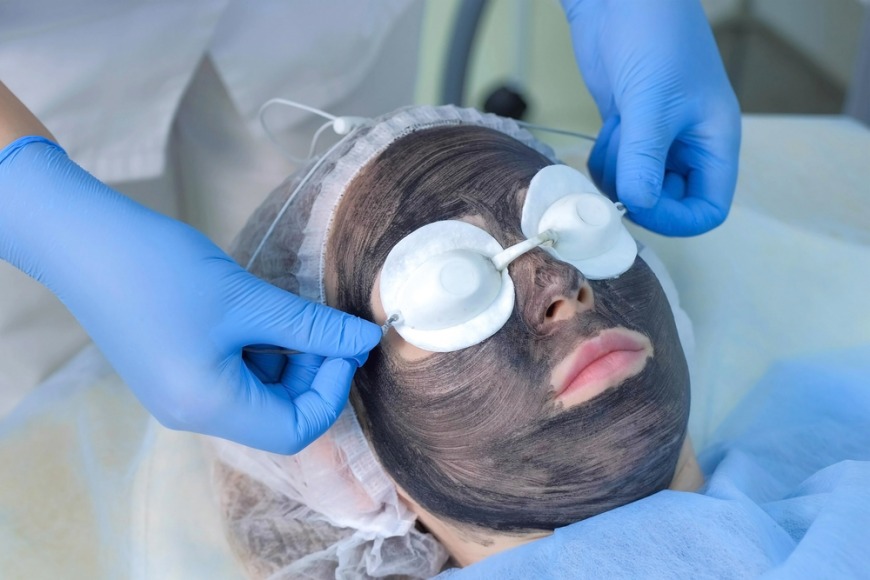 Best carbon laser treatment in Dubai